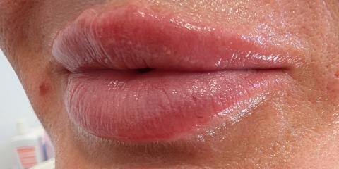 Aumento de labios
