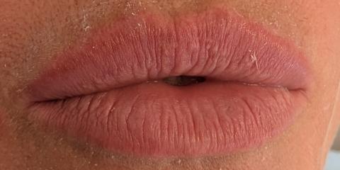 Aumento de labios